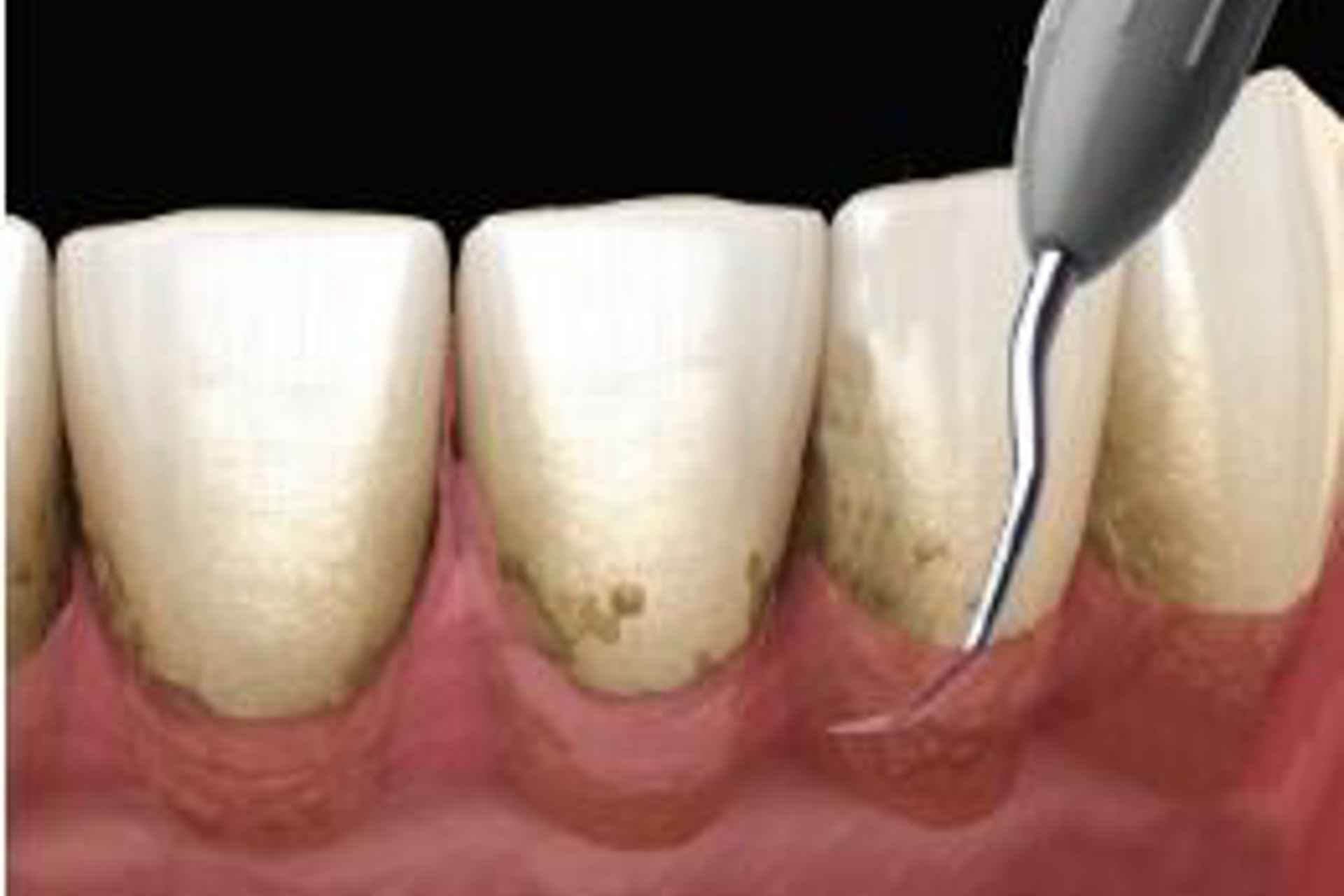 Fig 2A (1) Gum Disease - Management of Gum Diseases