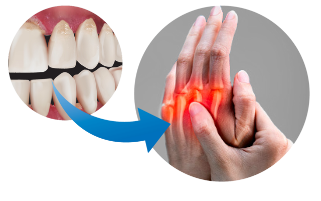 Figure 6B Gum Disease And Rheumatoid Arthritis