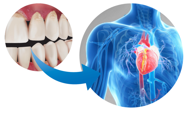 Figure 6C Gum Disease And Heart Health