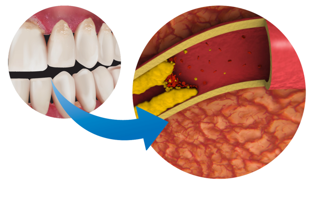 Figure 6A Gum Disease And Blocked Arteries