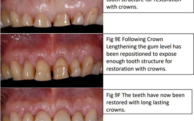 Figure 9D 9F Crown Lenthening