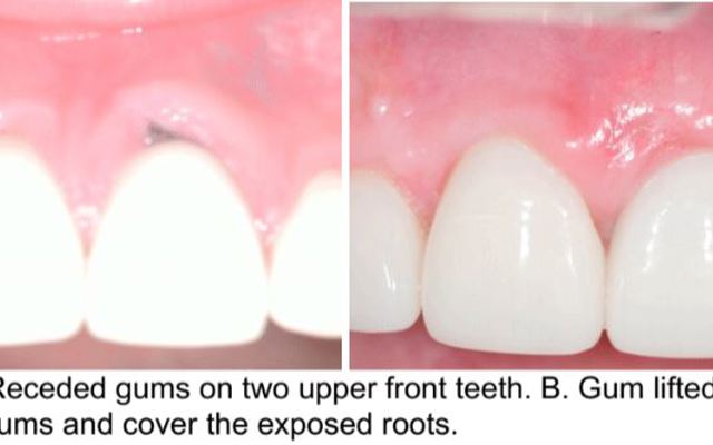 Figure 12A 12B Gum Graft On Teeth