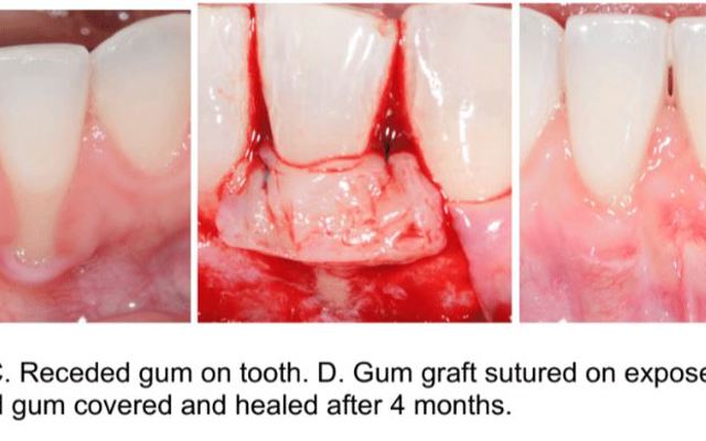 Figure 12C 12D Gum Graft On Teeth